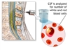 آزمایش و روش نمونه گیری از مایع مغزی نخاعی (CSF)